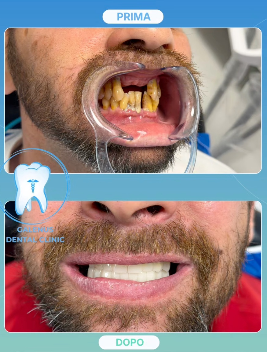 Sorriso di un paziente prima e dopo il trattamento