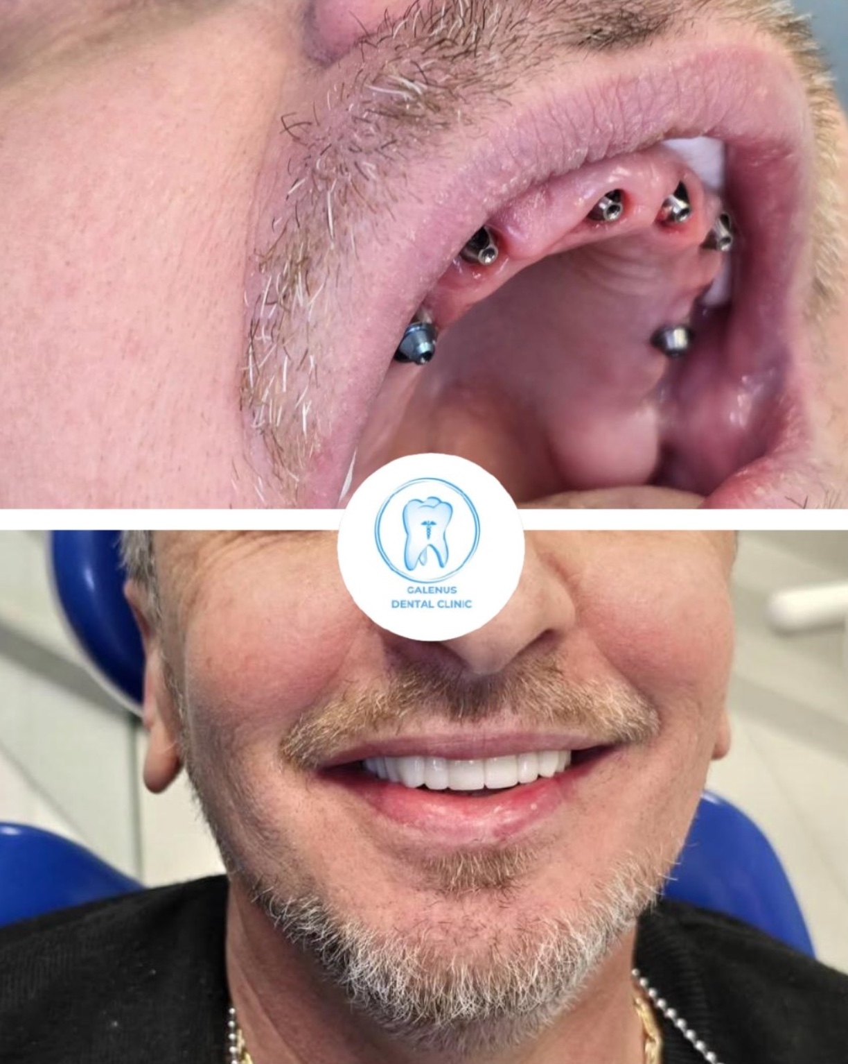Caso reale trattato presso Galenus Dental Clinic