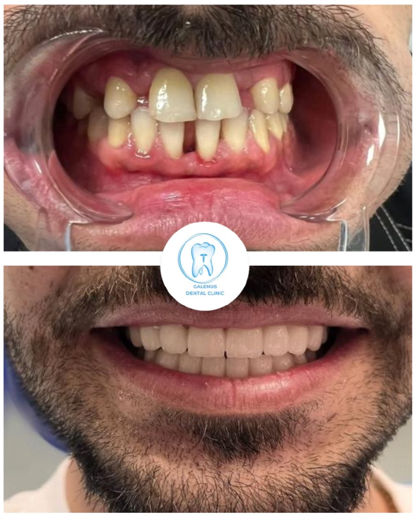 Sorriso di un paziente prima e dopo il trattamento